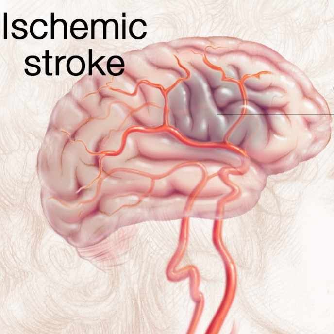 Future Prospects of the Acute Ischemic Stroke (AIS) Market Stakeholders to Witness Steady Growth