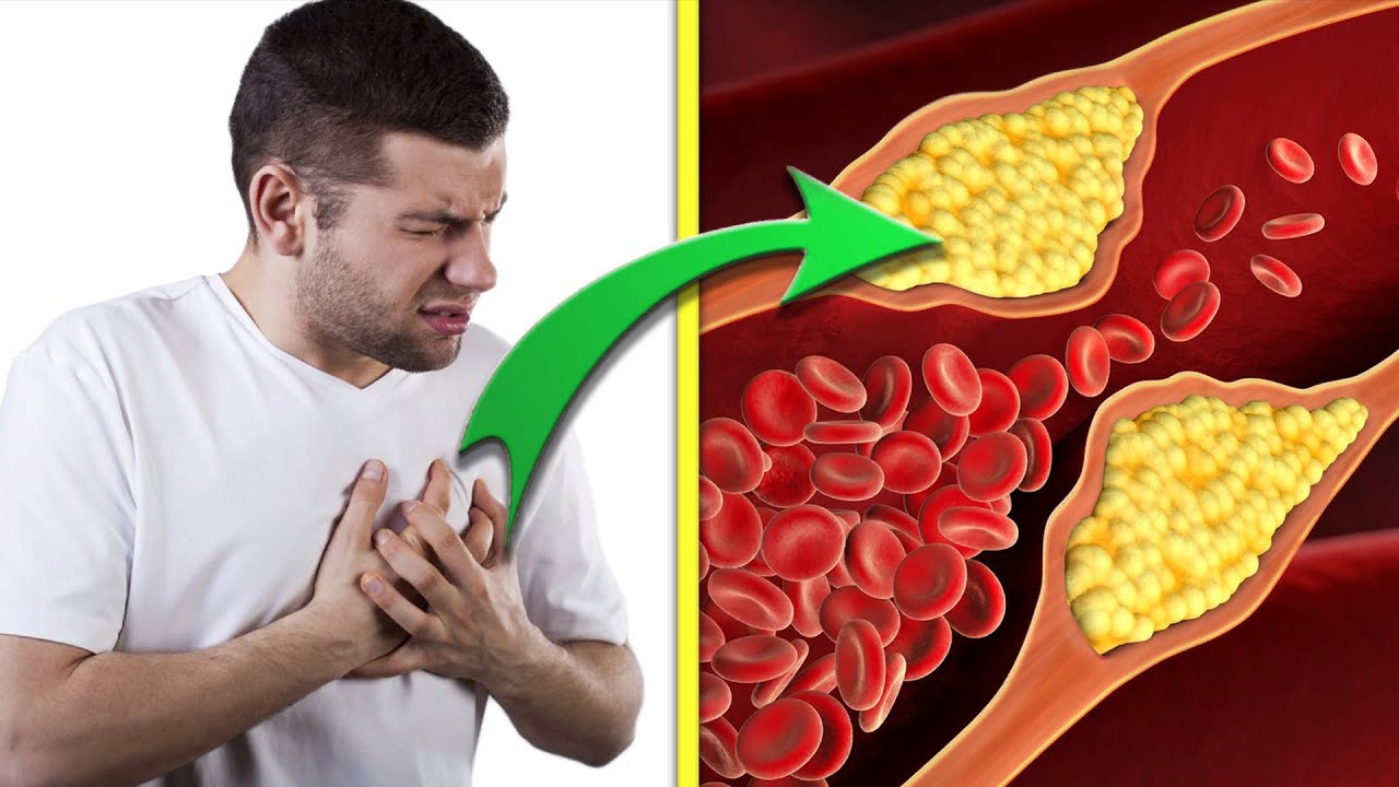 High Cholesterol Levels Identified as a "Silent Epidemic" in the UK