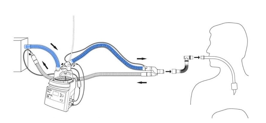 Ventilator Breathing Circuit Market to Reach US$ 1,207.0 Million by 2023, Exhibiting a CAGR of 4.1% from 2023 to 2030