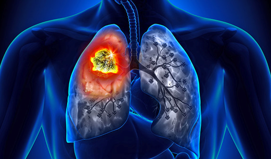 The Lung Cancer Surgery Market Is Estimated To Witness High Growth Owing To Increasing Prevalence Of Lung Cancer