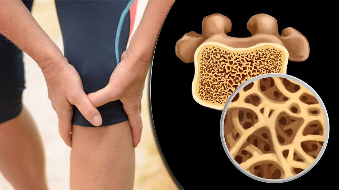 Postmenopausal Osteoporosis Market