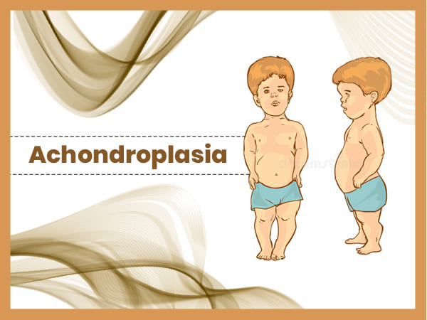 Achondroplasia Treatment Market