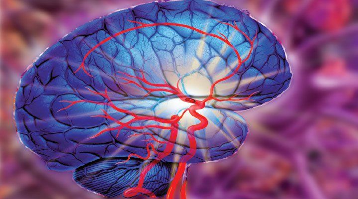 The Acute Ischemic Stroke (AIS) Market Is Driven By Rising Occurrence Of Ischemic Stroke