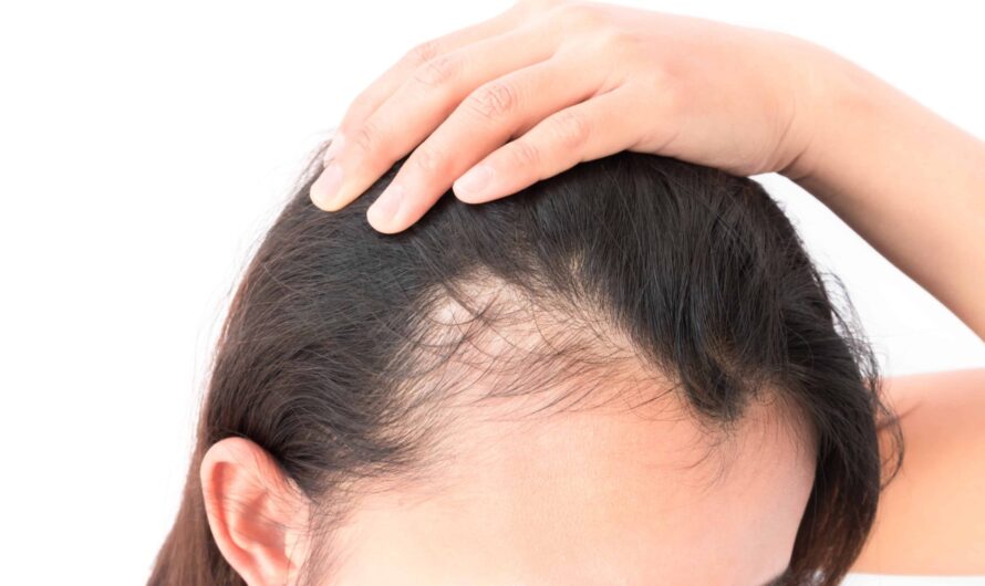 The Global Alopecia Treatment Market Is Driven By Increasing Prevalence Of Alopecia Areata