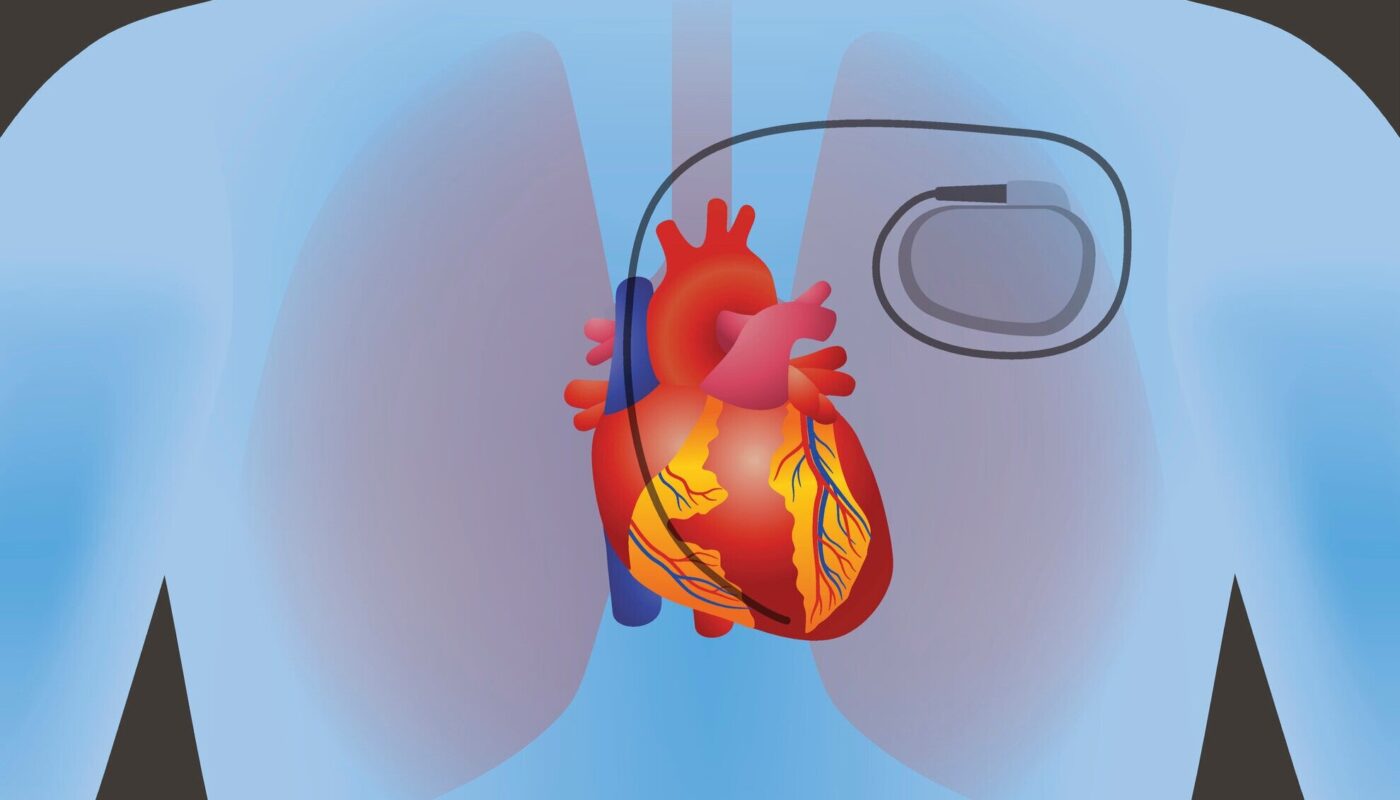 Cardiac Implantable Electronic Device Market