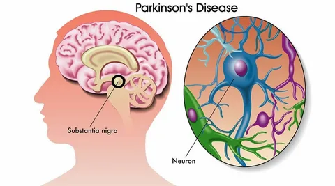 Groundbreaking Research Provides Strong Results For Parkinson’s Disease Treatment