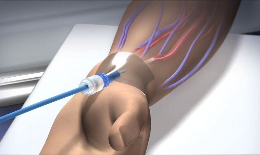 Breakthrough Endovascular Catheter Reduces Blockages In Small Lung Arteries