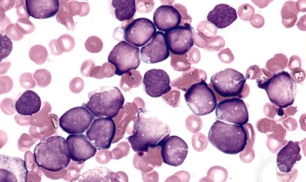New Research Advances Pediatric Acute Myeloid Leukemia (pAML) Treatment Options