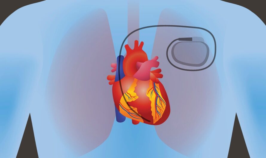 Cardiac Pacing Leads Market Is Expected To Be Flourished By Growing Demand For Technologically Advanced Products