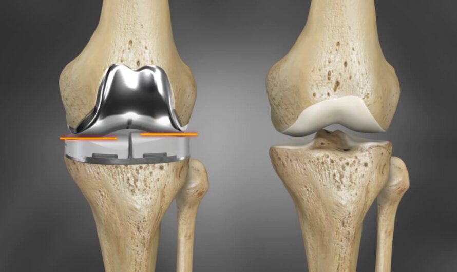 Collagen Meniscus Implant Market Is Estimated To Witness High Growth Owing To Rising Orthopedic Procedures For Sports Injuries