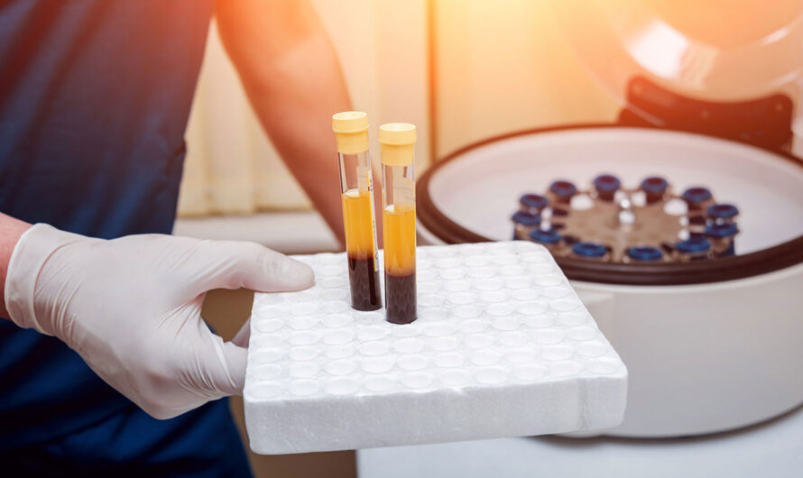 Europe Platelet Rich Plasma Market Expected To Show Steady Growth Due To Extensive Applications In Orthopedic Surgeries
