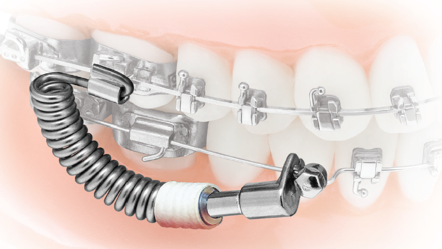 Orthodontics Market Is Expected To Be Flourished By Growing Adoption Of Dental Braces In Adolescents
