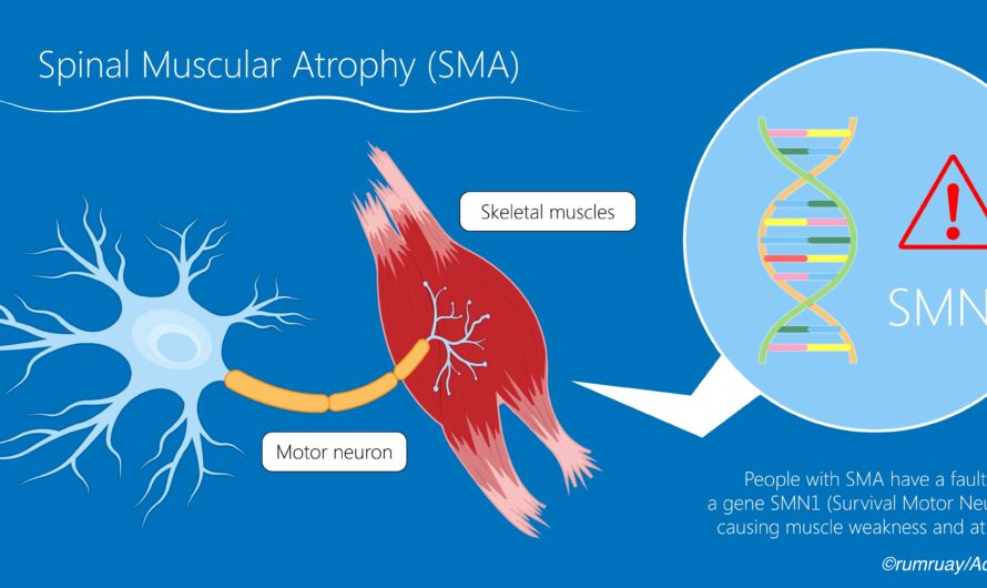 Spinal Muscular Atrophy Market is expected to be Flourished by Increasing Gene Therapies