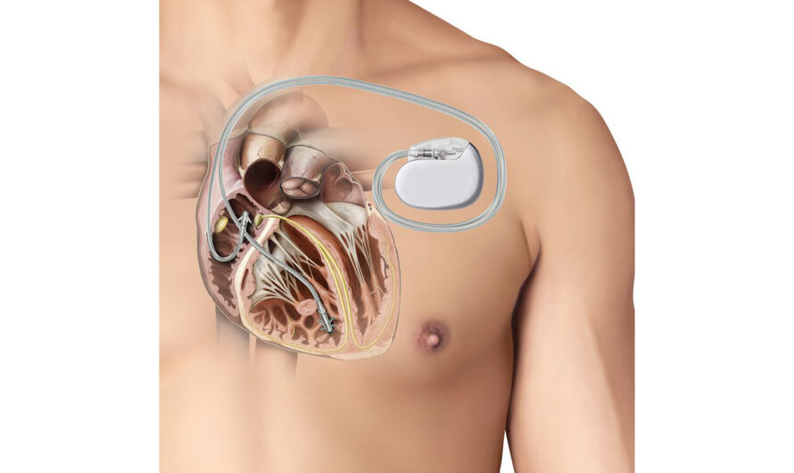 Set to Become Leader in Brazil Cardiac Pacemaker Production and Usage