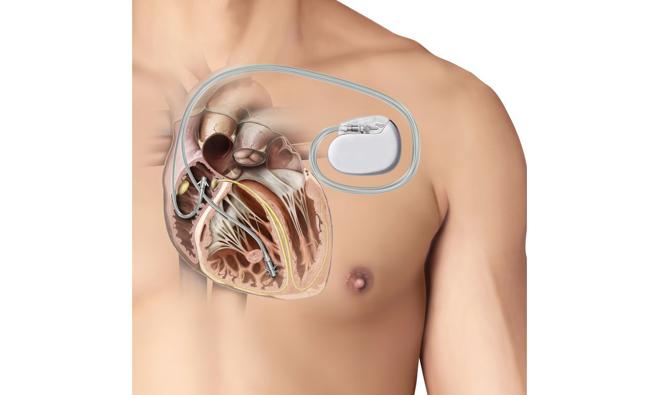 Brazil Cardiac Pacemakers