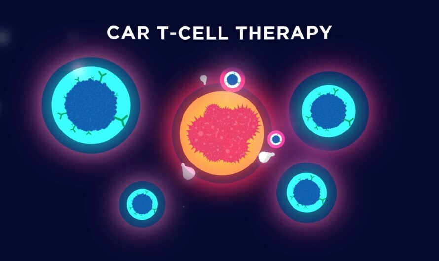 CAR T Cell Therapy: A Revolutionary Approach in Cancer Immunotherapy