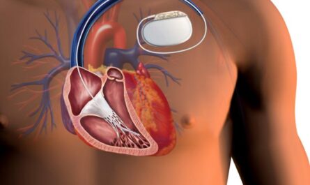 Cardiac Pacing Leads