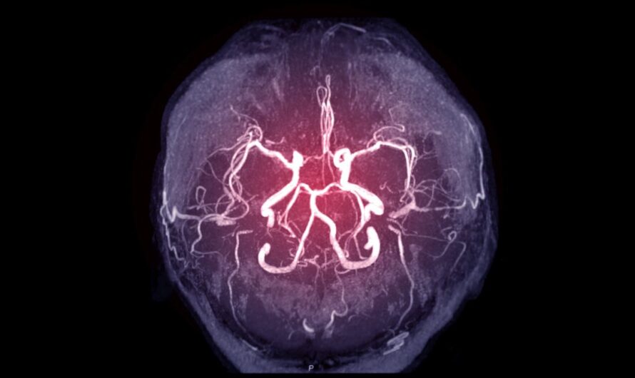 Cerebral Angiography: A Valuable Diagnostic Tool for Brain Conditions