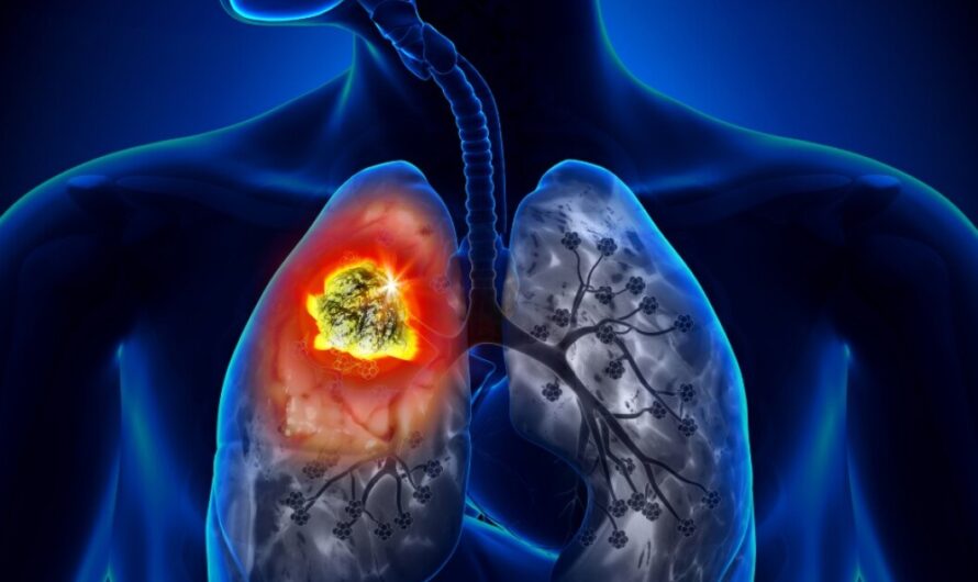 Lung Cancer Diagnostic And Screening: Introduction One Of The Main Ways Lung Cancer