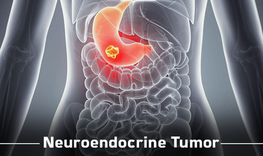 Neuroendocrine Tumor Treatment Market Is Estimated To Witness High Growth Owing To Rising Prevalence Of Neuroendocrine Tumors