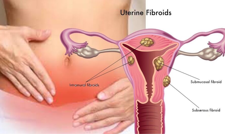New Findings Unveil Additional Genes Linked to the Development of Uterine Fibroids