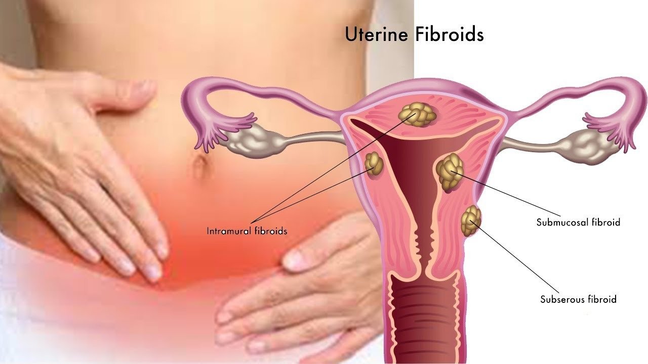 New Findings Unveil Additional Genes Linked to the Development of Uterine Fibroids