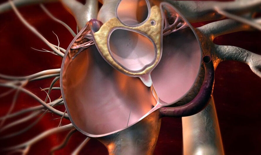 The Patent Foramen Ovale (PFO) Is A Flap-Like Opening Between The Left And Right Atria Of The Heart