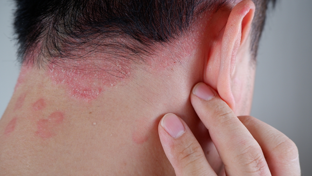 Psoriasis,On,The,Nape,Of,A,Man.,Skin,With,Psoriasis.