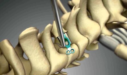 Spinal Laminoplasty